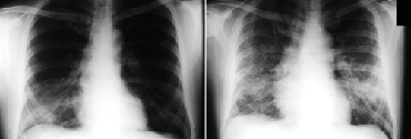 Røntgenbilleder af lungerne på en patient der er smittet med SARS