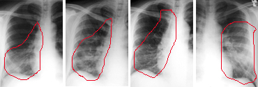 Røntgenbilleder af den meget smitsomme lungesygdom SARS