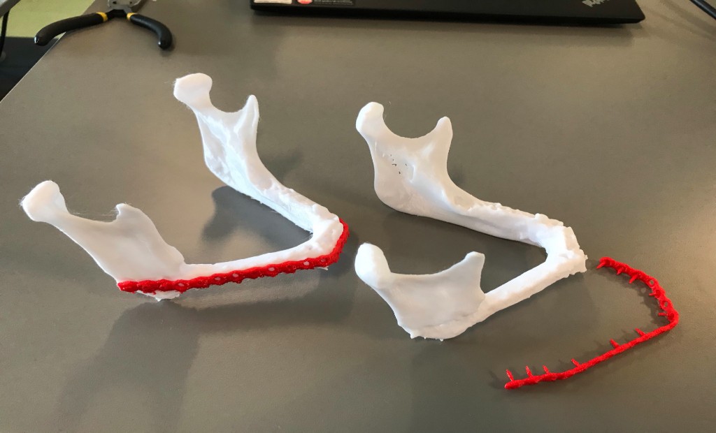 Underkæber der tidligere har fået sat en titaniumskinne fast i forbindelse med en operation