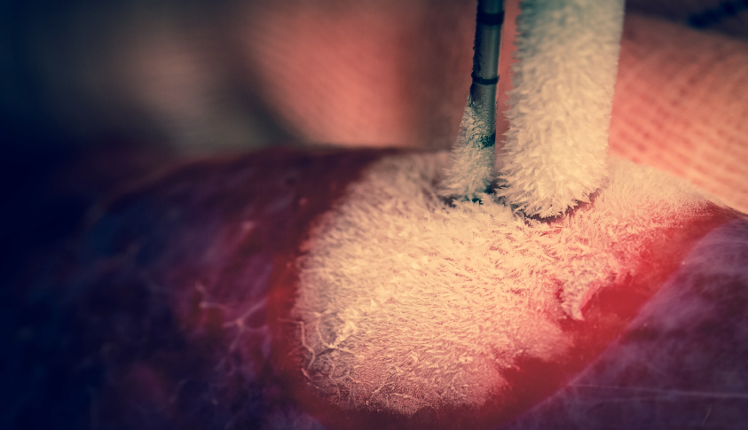 Frysebehandling for nyrekræft foretages ved, at man stikker en tynd frysenål direkte ind i kræftknuden i nyren
