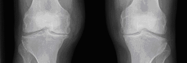 Røntgenbillede af knæ som trænger til hjælp - f.eks. hos jubilarerne på Regionshospitalet Holstebro